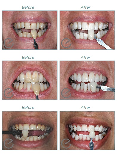 teeth whitening Hertfordshire